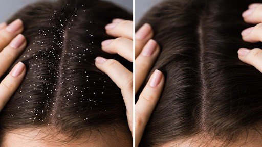 Anti-Dandruff Treatment